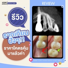 คลิกเพื่อดูเคสรากฟันเทียม